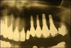 implants dans greffe osseuse 2