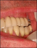 implants dans greffe osseuse 3