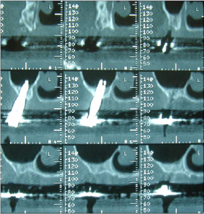 sinus-lift