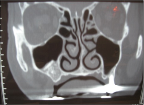 sinus-lift-apres